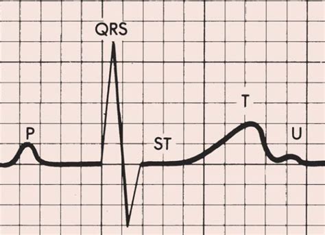 ECG T Wave .
